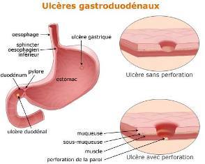 Ulcère gastro-duodénal